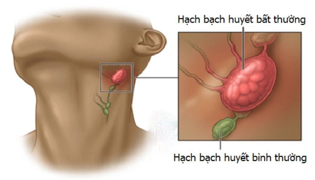 4-hach-bach-huyet.jpg