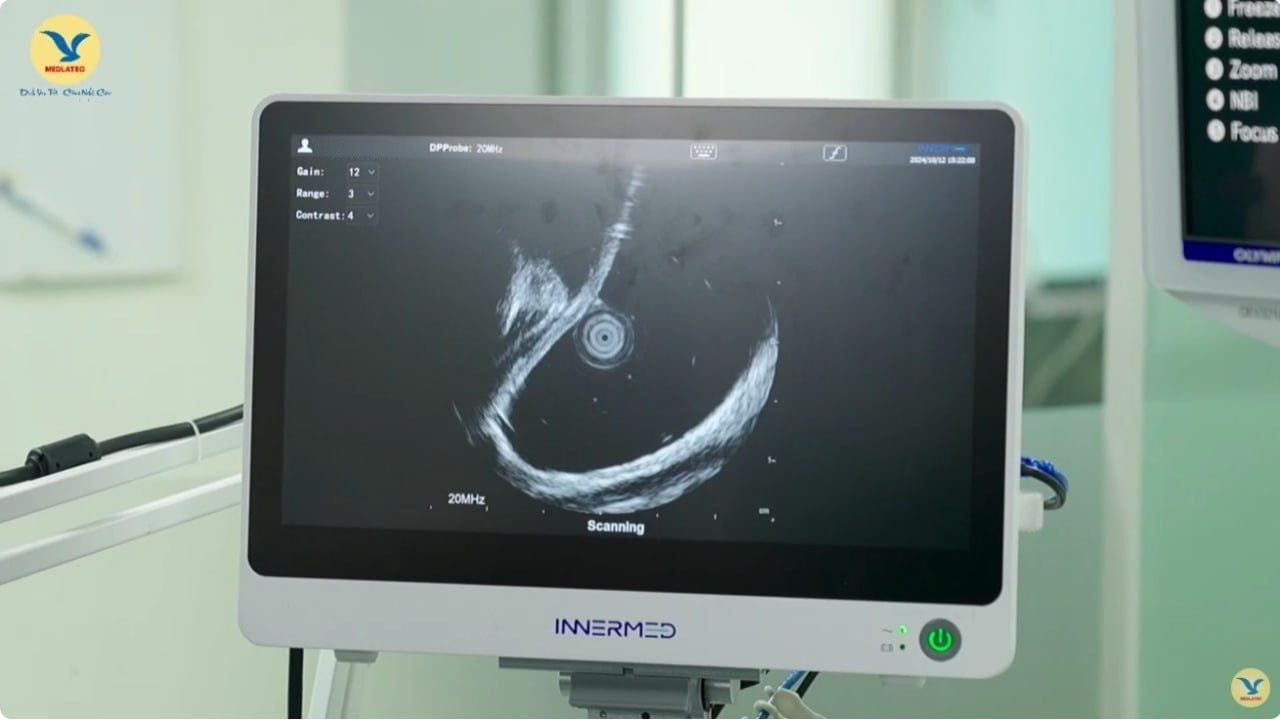 noi-soi-sieu-am-medlatec-2 noi-soi-sieu-am-medlatec-2.jpg